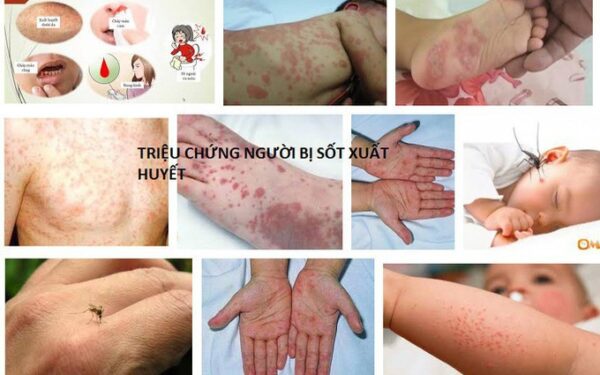 Bạn đã hiểu gì về bệnh sốt xuất huyết