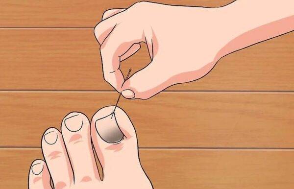 Sứt móng chân, làm sao để mọc lại?