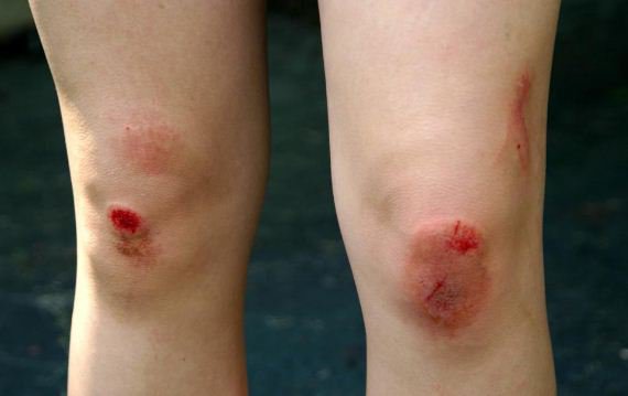 Thâm tím và chảy nước vàng ở đầu gối sau té ngã, xử trí sao?