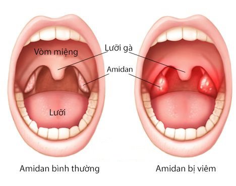 Bệnh học viêm amidan