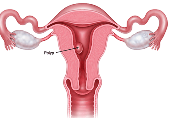 Polyp tử cung