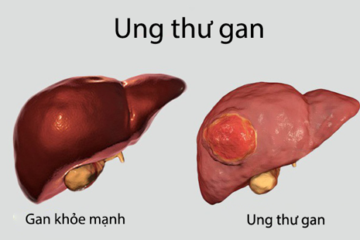 Điều dưỡng chăm sóc bệnh nhân ung thư gan giai đoạn cuối