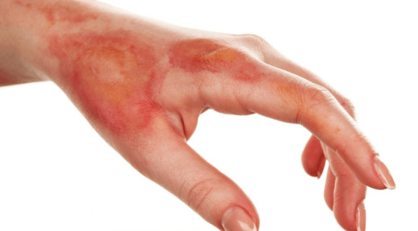 Dấu hiệu triệu chứng lâm sàng sốc bỏng