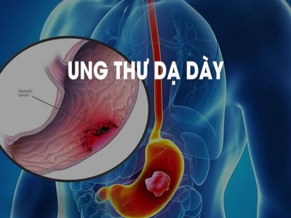 Sự kết hợp thuốc mới mang lại nhiều hứa hẹn trong điều trị ung thư dạ dày