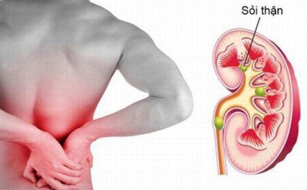 Phác đồ điều trị nội khoa sỏi thận tiết niệu