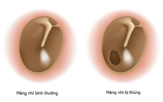 Thủng màng nhĩ