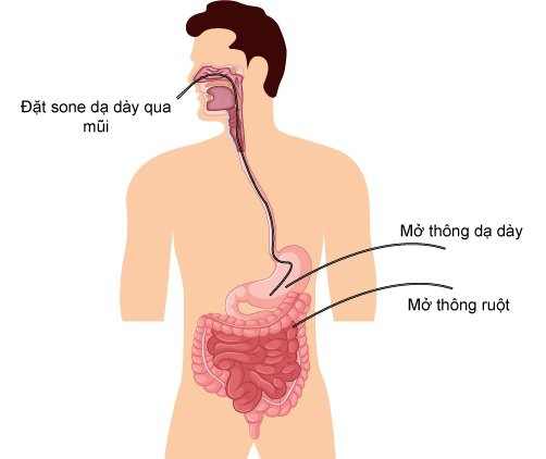 Kỹ thuật đặt ống thông dạ dày