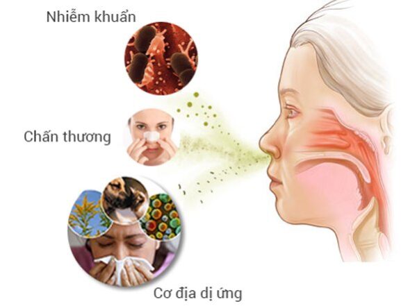 Bệnh học viêm mũi dị ứng