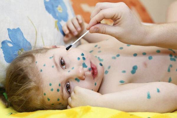 Bị thủy đậu phải làm sao và cách phòng tránh hiệu quả