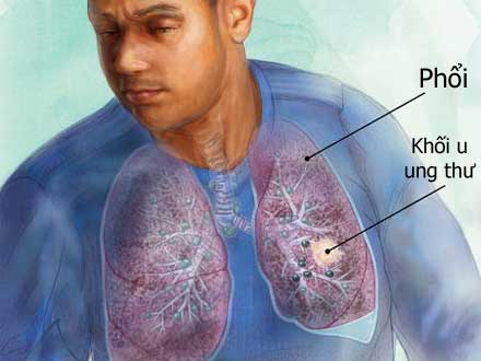 Bước đột phá trong điều trị ung thư Phổi