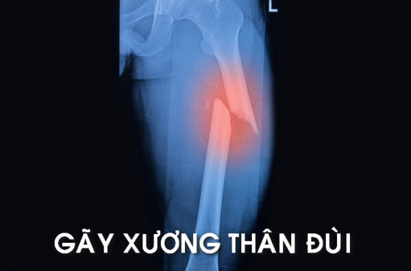 Gẫy thân xương đùi