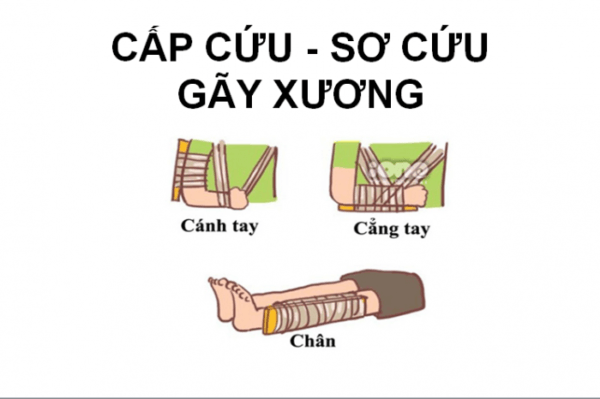 Kỹ thuật sơ cứu gãy xương