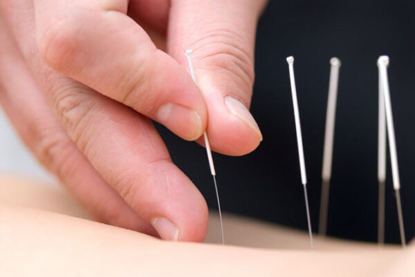 Thủy châm điều trị liệt nửa người do tai biến mạch máu não