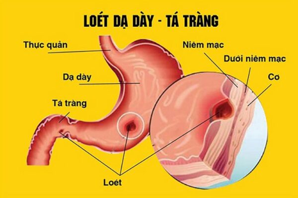 Điều dưỡng chăm sóc bệnh nhân loét dạ dày tá tràng