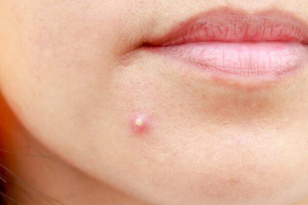 Phác đồ điều trị trứng cá (acne)