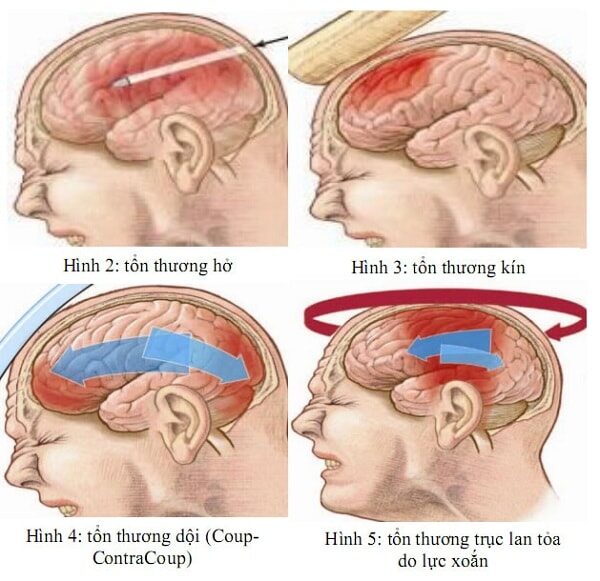 Bệnh học ngoại chấn thương sọ não kín