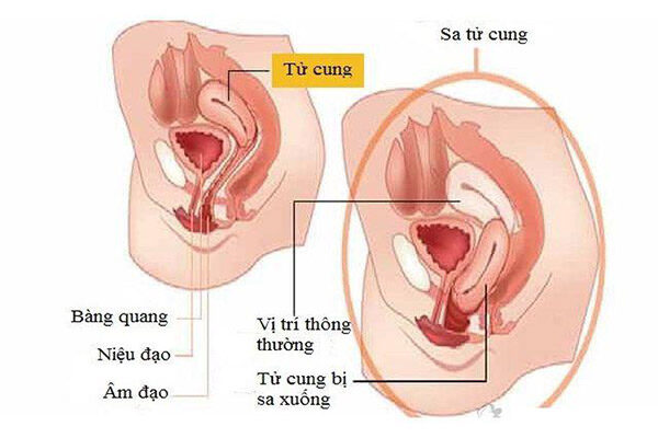 Sa tử cung