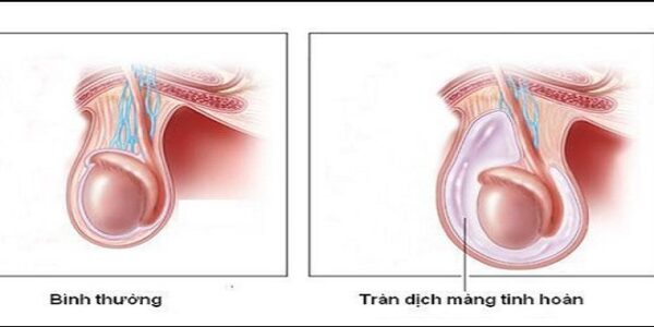 Tràn dịch tinh mạc ở trẻ em