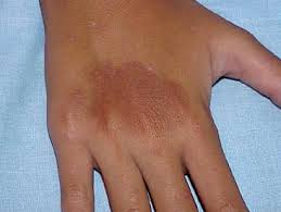 Phác đồ điều trị bệnh da do ánh sáng (Photodermatosis)