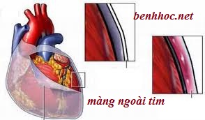Bệnh học viêm màng ngoài tim