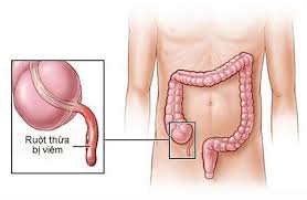 Viêm ruột thừa cấp