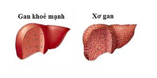 Những bài thuốc dân gian trị bệnh xơ gan sỏi mật và đau bao tử