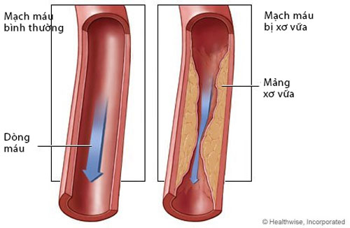 Bệnh học xơ vữa động mạch