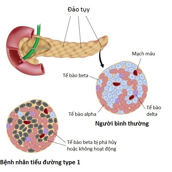 Sự phối hợp mới thuốc điều trị đái tháo đường làm tăng tỷ lệ tái tạo tế bào beta ở người