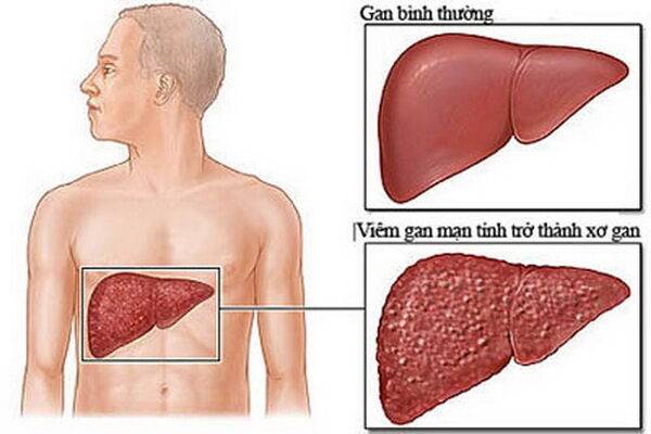 Bài thuốc trị viêm gan mạn