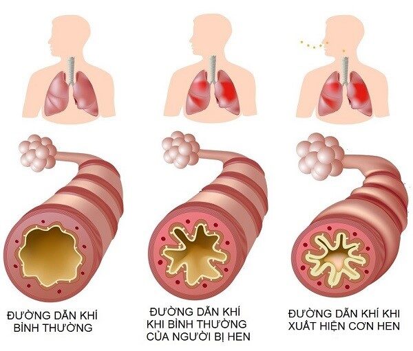 Nguyên tắc điều trị hen phế quản
