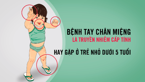 Chủ động phòng chống bệnh tay – chân – miệng