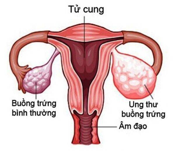 Những điều cần biết về ung thư buồng trứng