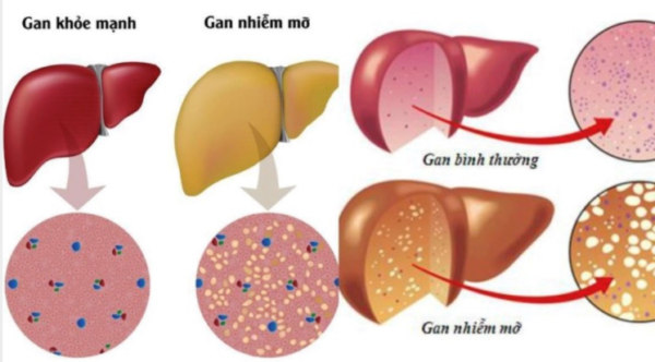 Hiểu đúng về gan nhiễm mỡ trên siêu âm