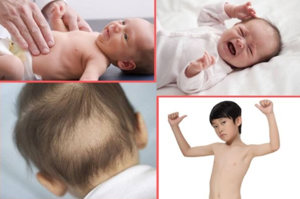 Còi xương ở trẻ em: Những điều cần biết