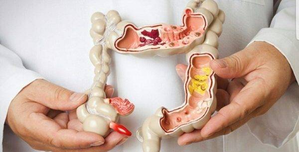 Ung thư đại trực tràng ngày càng trẻ hóa