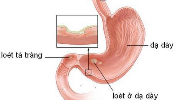 Dùng thuốc giảm đau, coi chừng loét dạ dày – tá tràng