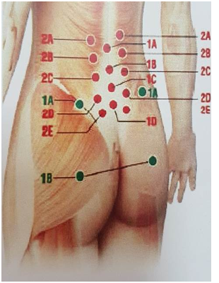 Điều trị đau thần kinh tọa do thoát vị đĩa đệm bằng tiêm Collagen