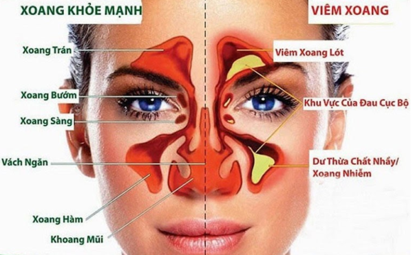 Viêm xoang: Nguyên nhân, triệu chứng, chẩn đoán và điều trị