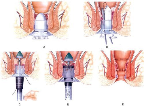 Điều trị bệnh Trĩ bằng phương pháp điều trị ngoại khoa