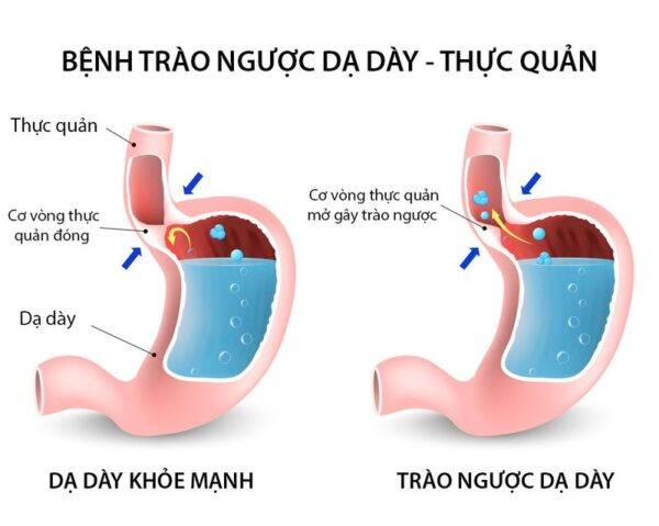 Trào ngược dạ dày ở trẻ em và cách xử trí