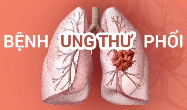 Những điều cần biết về loại ung thư nguy hiểm nhất thế giới