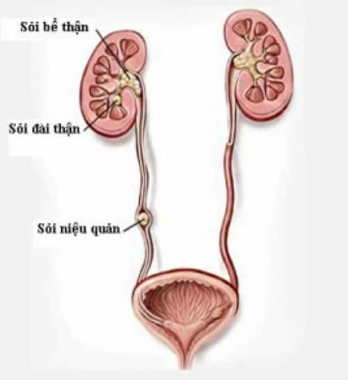 Sỏi niệu quản – Lựa chọn dinh dưỡng đúng để giảm nguy cơ tái phát