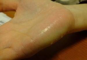 Phẫu thuật nội soi điều trị chứng tăng tiết mồ hôi tay