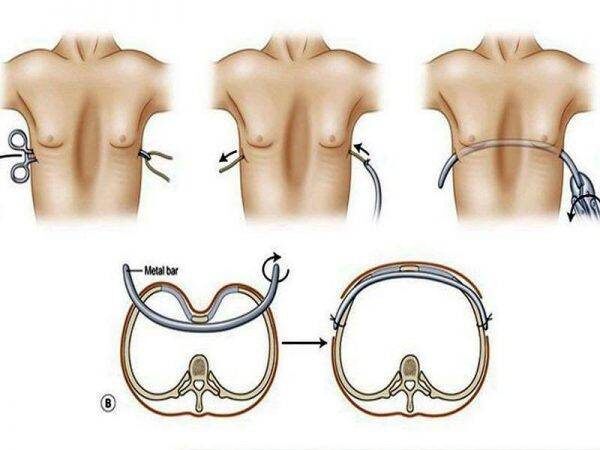 Lõm ngực bẩm sinh: Dấu hiệu nhận biết và phương pháp điều trị